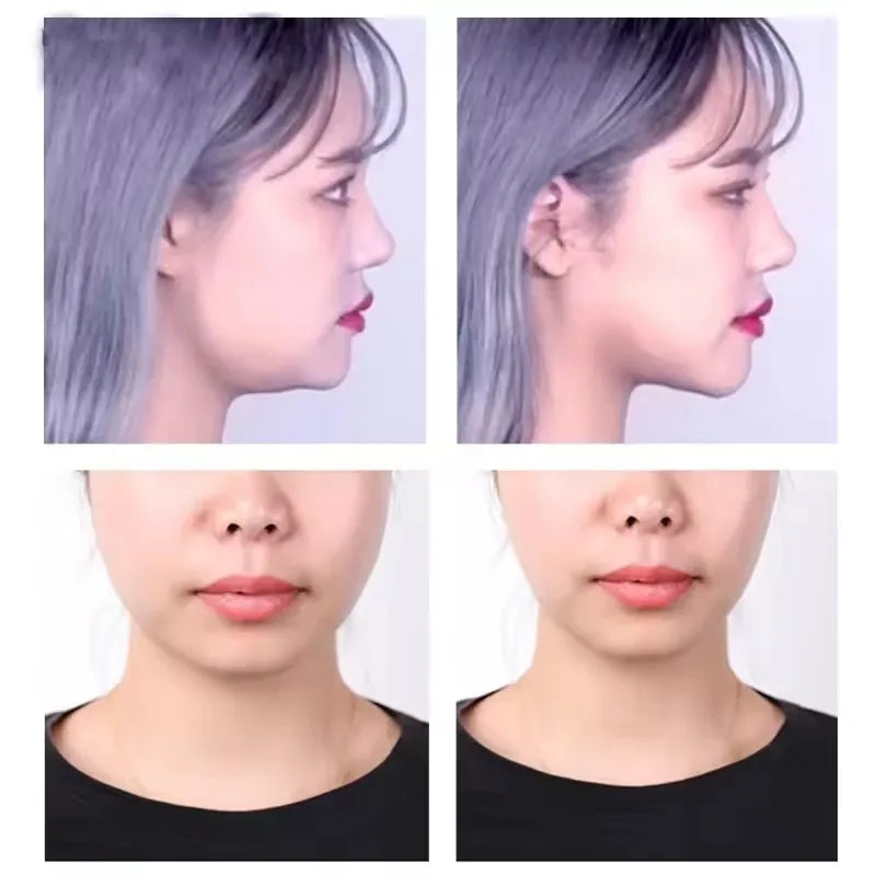 Close-up images showing invisible V-shape face lifting adhesive patches applied to the side profile and front of a woman's fa